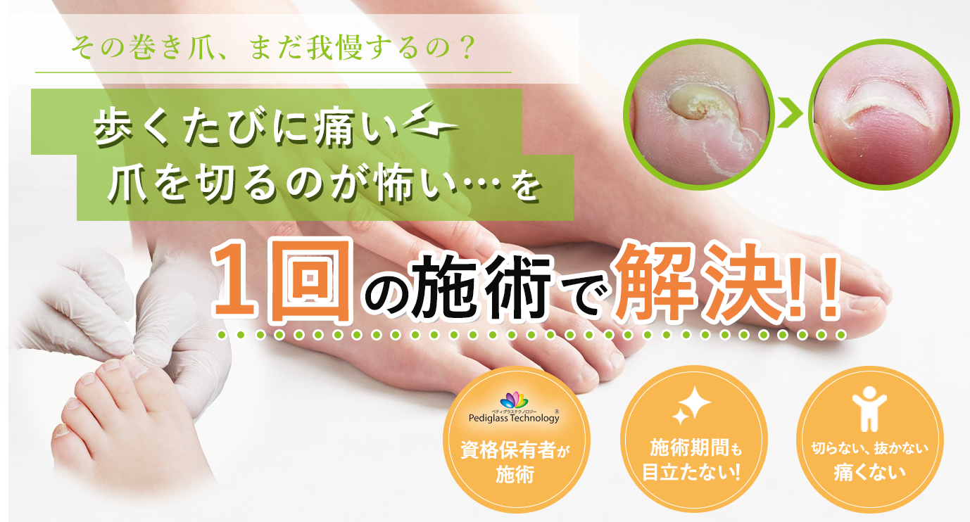 南九州市で巻き爪を改善するなら、鹿児島巻き爪治療院へご相談ください